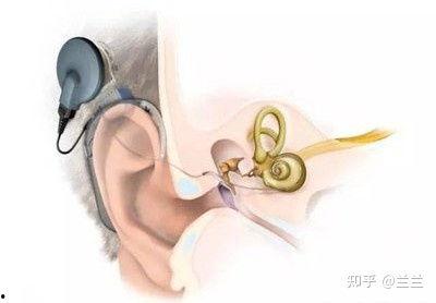 成人耳蜗训练视频,开启听觉新篇章